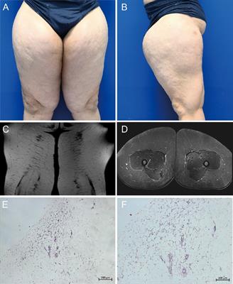 Madelung disease with postoperative priapism and multiple venous thromboses: case report and literature review